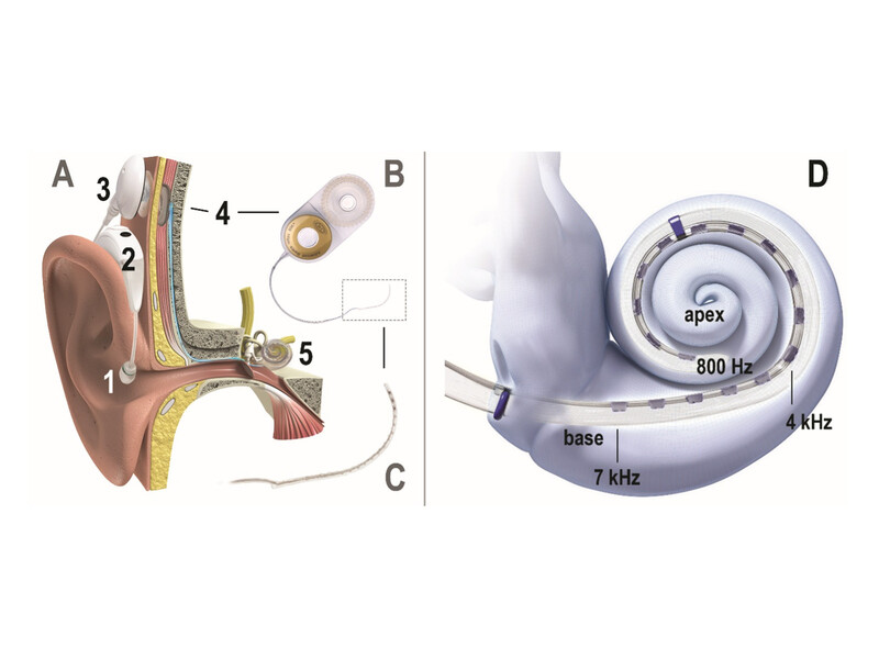 OtoControl-2.0: naar betere afstemming van cochleaire implantaten